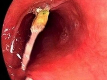 Kinh hoàng người đàn ông bị cưa máy cắt ngang bụng, đùi vẫn sống sót-2