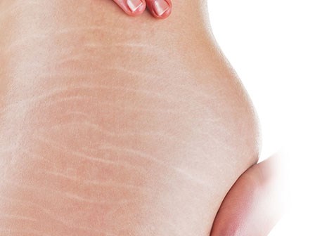 Đã tìm ra cách thổi bay các vết rạn da xấu xí cho chị em sau sinh