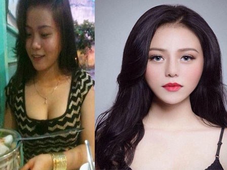 4 thủ thuật thẩm mỹ nhiều phụ nữ Việt rắp tâm thực hiện