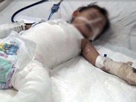 Mẹ đi vệ sinh, bé gái 2 tuổi bị cả nồi canh đang sôi đổ lên người