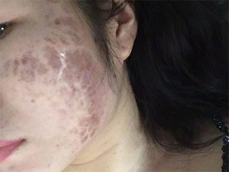 Lăn kim - Phương pháp làm đẹp được cho là 