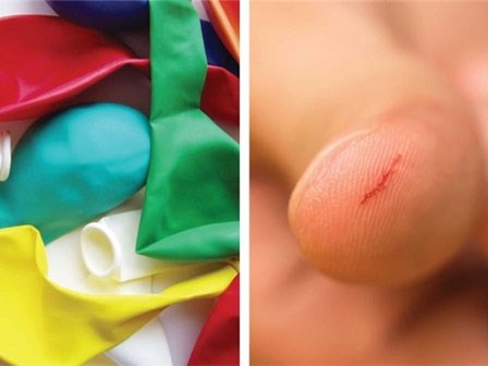 9 mẹo sơ cứu thông minh ngay tại nhà mà bạn nên biết