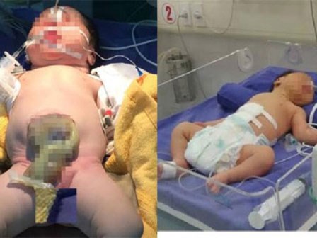 Cứu sống bé sơ sinh 1 giờ tuổi lộ nội tạng ra ngoài thành bụng