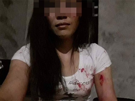 Bị chồng đánh rách thịt, người vợ tự lấy kim khâu vết thương