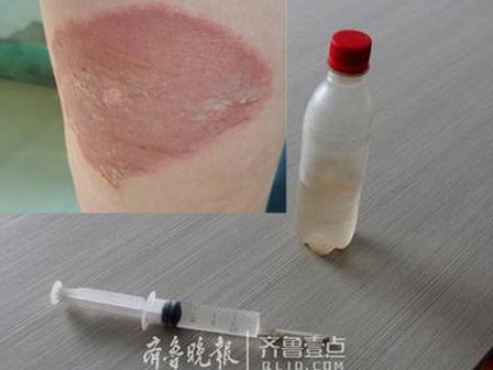 Nam thanh niên bệnh hoạn tấn công các thiếu nữ bằng kim tiêm chứa axit ăn mòn cơ thể