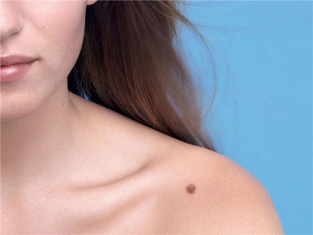 Nếu có 1 trong những vết bớt này, đảm bảo bạn sẽ được cả đời sung sướng