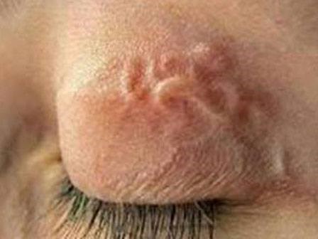 Nhiễm cả búi sán từ những món ăn khoái khẩu mà bạn không biết