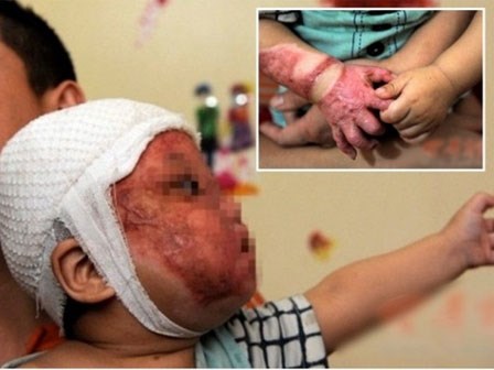 Xót xa bé một tuổi bị bỏng nặng vì ngã vào nồi nước nóng