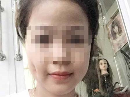 Mặt sưng vù vì làm má lúm đồng tiền giá rẻ