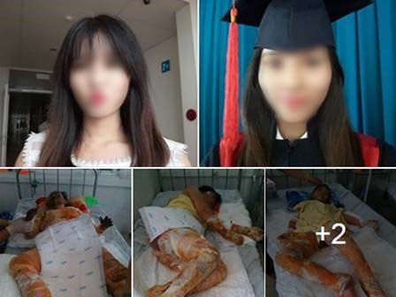 Xót thương cô gái xinh đẹp bị bỏng toàn thân, khuôn mặt biến dạng sau tai nạn