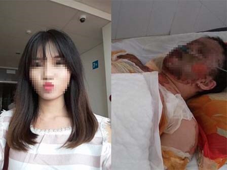 Cha cô gái xinh đẹp bị bỏng nặng sau TNGT: