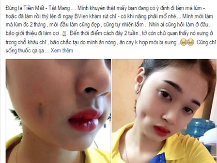 Cô gái xinh đẹp tố cơ sở thẩm mỹ giá rẻ làm má lúm đồng tiền hỏng khiến mặt bị biến dạng