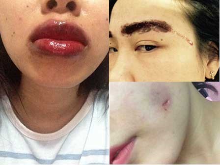 Loạt biến chứng nhìn là thấy sợ từ những cuộc 