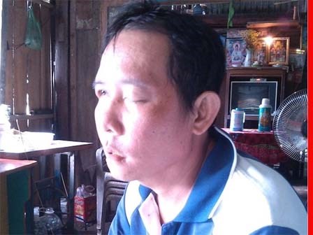Tài xế xe tải khốn khổ vì nhổ răng bị mù mắt