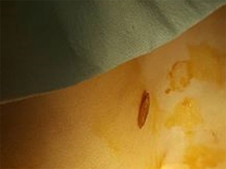 Bé gái bị dị vật lọt vào âm đạo khiến người nhà tá hỏa