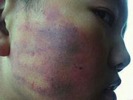 Chỉ vì làm sai bài tập về nhà, bé trai 6 tuổi bị cô giáo tát sưng mặt mũi