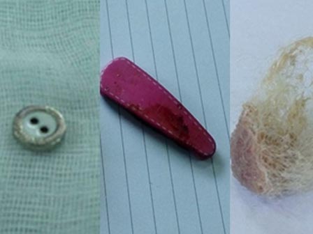 Lấy thành công chiếc chìa khóa trong bụng bé trai 5 tuổi mà không cần phẫu thuật-4