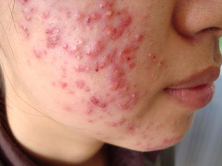 Mua kem trộn làm trắng da qua mạng xã hội: Người sử dụng lãnh đủ hậu quả-3