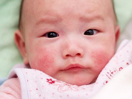 3 mẹo dân gian trị bệnh chàm ở trẻ sơ sinh không phải mẹ nào cũng biết