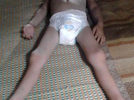 Bé trai bị liệt hai chân sau mổ ruột thừa, gia đình đâm đơn khiếu nại