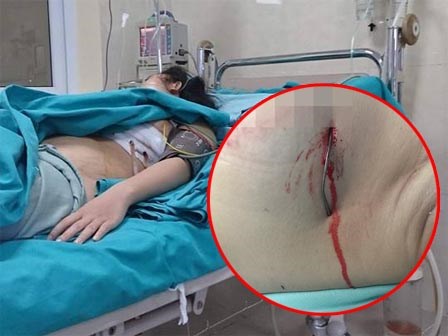 Đang đi đường, người phụ nữ trẻ nguy kịch vì bị kim loại nhọn cắm sâu vào ngực