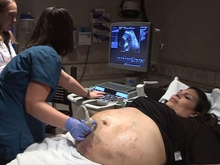 Mới mang bầu đã thấy nhiều vết thâm tím, bà mẹ ‘sốc nặng’ khi nhận tin từ bác sĩ