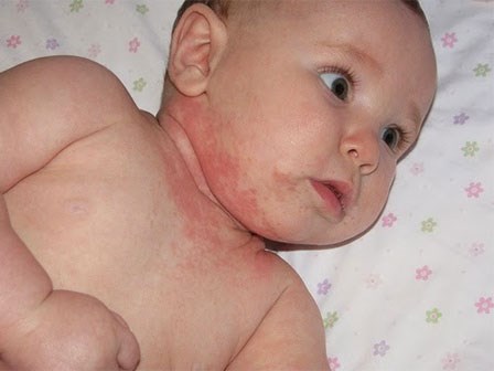 Cách chăm bé khi bị bệnh không cần dùng kháng sinh, mẹ lưu lại khi cần