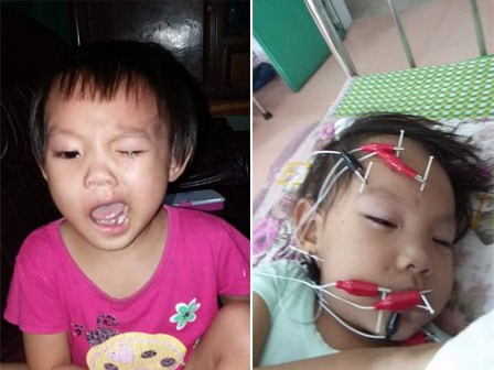 Mẹ tá hỏa phát hiện con bị méo miệng, liệt mặt chỉ sau 1 đêm trời trở gió