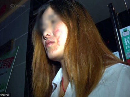 Đi ăn lẩu, cô gái bất ngờ bị nhân viên cửa hàng làm cháy mặt