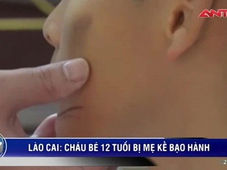 Phẫn nộ bé 12 tuổi bị mẹ kế, bố đẻ dùng chày đánh đập phải nhập viện