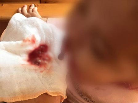 Bé gái 2 tuổi nôn ra máu, nguyên do đau lòng chính là thói quen xấu của người lớn
