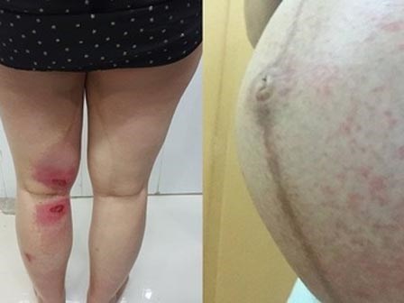 Một sản phụ chân bỏng rát, nổi nhiều bóng nước, bụng nổi ban do nghi bị kiến ba khoang cắn