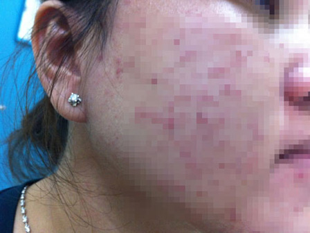 Hải Phòng: Đi spa tắm trắng, cô gái phải nhập viện cấp cứu và nguy cơ bị viêm thận?-9