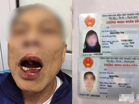 Tiến sĩ 76 tuổi bị đánh nhập viện khi đi tập thể dục