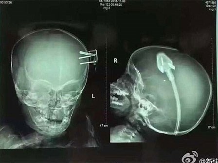 Rơi khỏi giường trong lúc chơi, bé trai 2 tuổi bị phích cắm xiên vào não