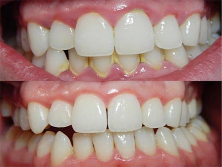 Dành 3 phút buổi tối làm việc này thì cả đời không cần đi nha sĩ lấy cao răng