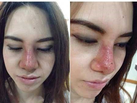 Cảnh báo: Nếu cứ tiếp tục nặn mụn ở vùng da này, bạn sẽ có nguy cơ tử vong đấy