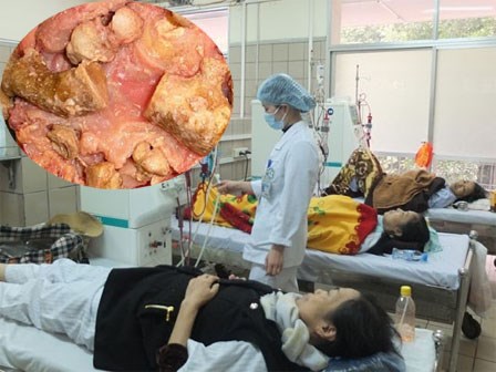 Tự chữa sỏi thận: Tiêu sỏi tiêu luôn cả thận