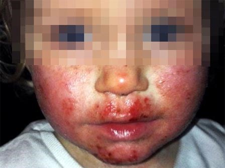 Khuôn mặt bé gái 2 tuổi như bị 