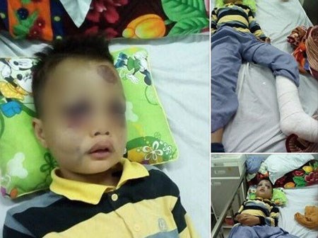 Dân mạng kêu gọi giúp đỡ cậu bé nghèo bị ngã từ sân thượng