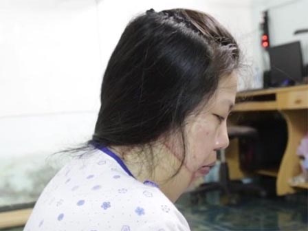 Sau bao đau đớn kinh hoàng, người phụ nữ bị tạt axit mong chờ ngày kẻ ác đền tội