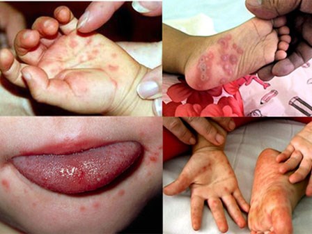 Những điều cha mẹ nào cũng nên biết khi bệnh tay chân miệng đang có dấu hiệu bùng phát