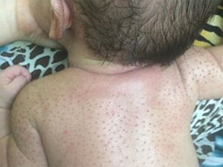 Trứng gà trộn nước chanh chữa vặn mình cho trẻ - cách làm sai mà vẫn được lan truyền rầm rộ