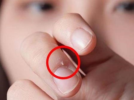 Bé 7 tuổi suýt bị cắt bỏ ngón tay vì thói quen 