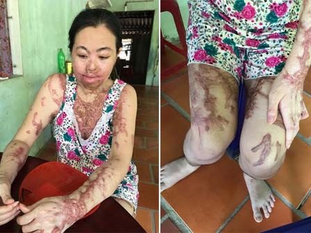 Uẩn ức người đàn bà bị tạt axít giữa Sài Gòn