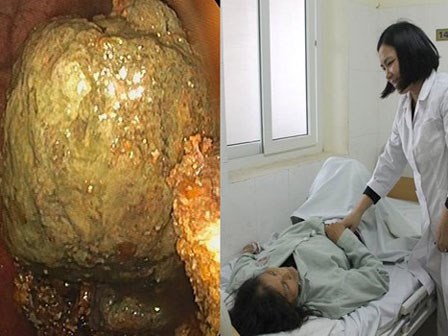 Suýt thủng ruột vì ăn hồng giòn