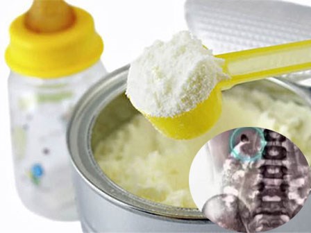 Bé 2 tuổi đã sỏi thận, bác sĩ sau khi khám mắng bố mẹ té tát vì lỗi pha sữa sai lầm