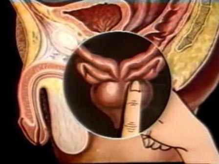 Căn bệnh ung thư nào đe dọa quý ông nhiều nhất?