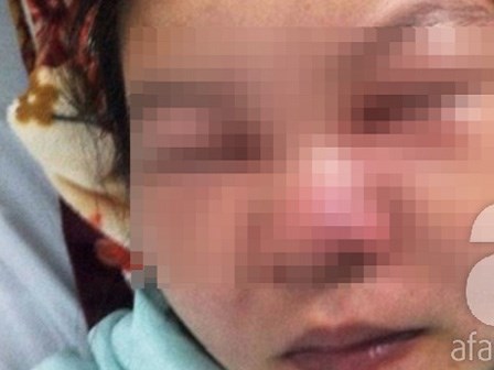 TP.HCM: Một phụ nữ suýt chết vì… nặn mụn