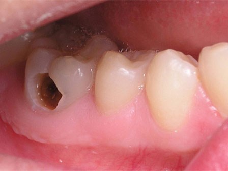Chớ coi thường cơn đau răng, đã có người chết trong đau đớn chỉ vì 1 cái răng sâu